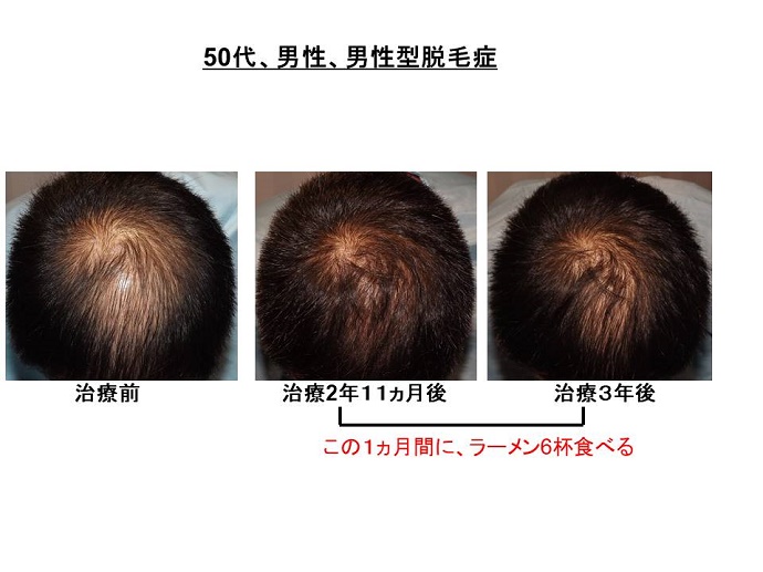 円形脱毛症　病院""